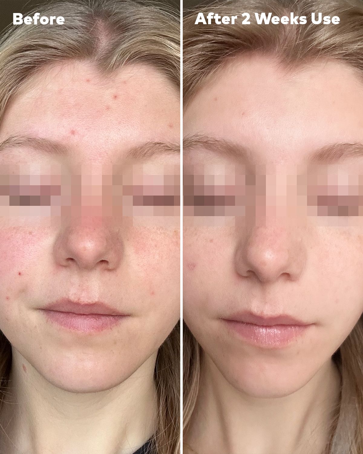 Silver Infused 7-Day Set | Designed for Blemish-Prone Skin