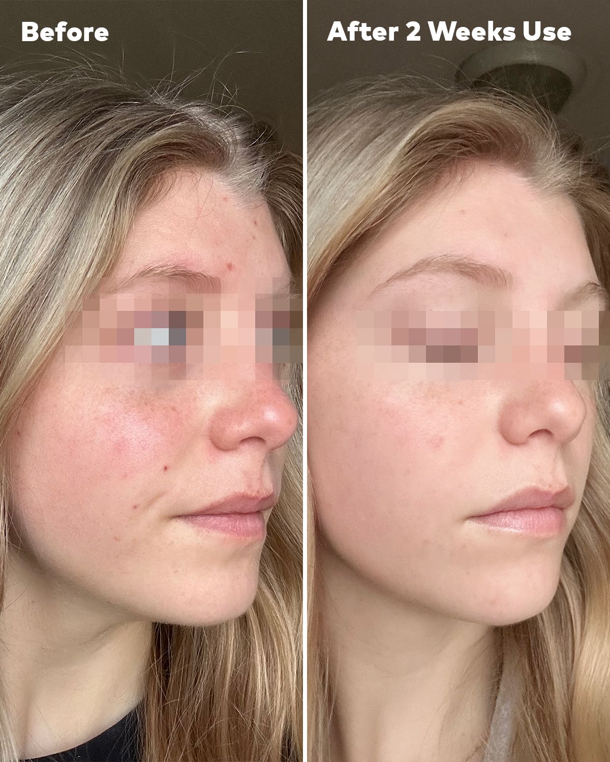 Silver Infused 7-Day Set | Designed for Blemish-Prone Skin